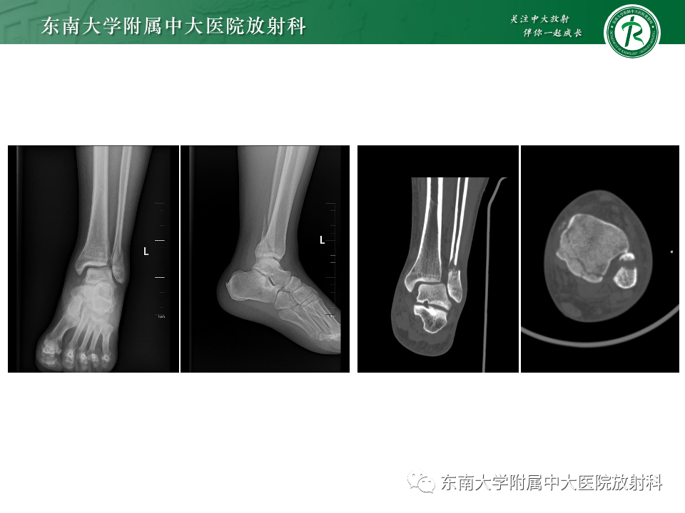 影像PPT - 【PPT】下胫腓联合分离损伤-23