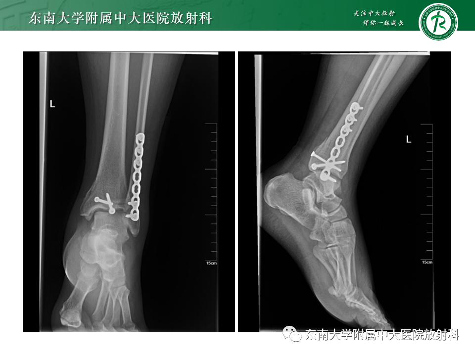 影像PPT - 【PPT】下胫腓联合分离损伤-25