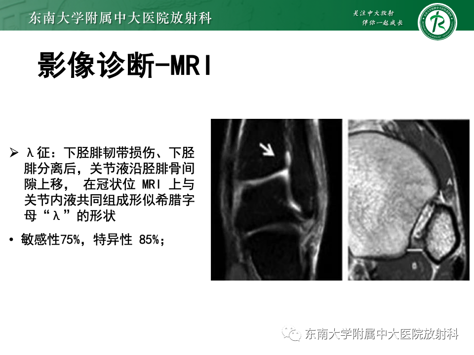 影像PPT - 【PPT】下胫腓联合分离损伤-27