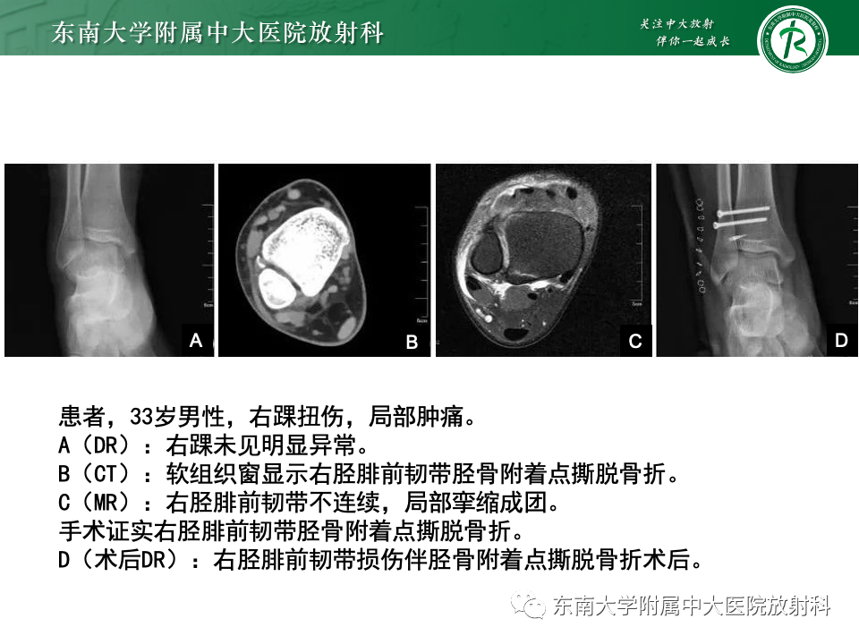 影像PPT - 【PPT】下胫腓联合分离损伤-30