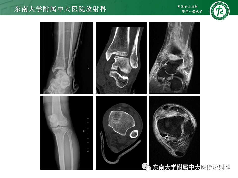 影像PPT - 【PPT】下胫腓联合分离损伤-33
