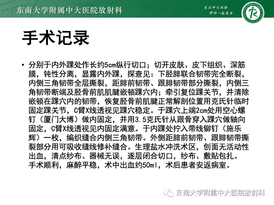 影像PPT - 【PPT】下胫腓联合分离损伤-34