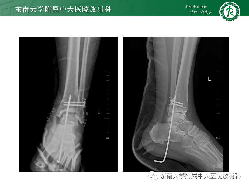 影像PPT - 【PPT】下胫腓联合分离损伤-35