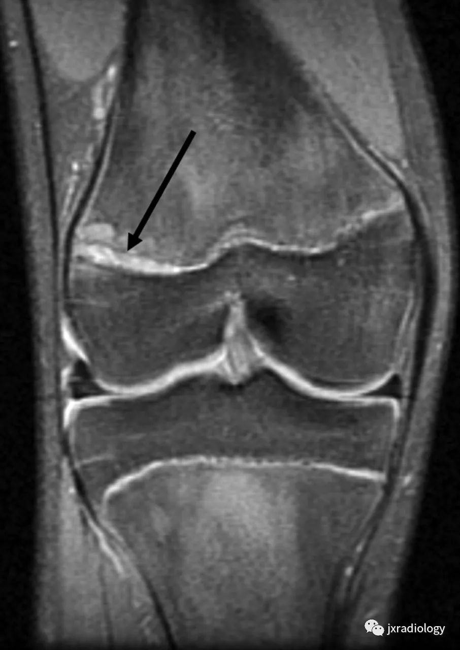 影像PPT - 认识青少年运动损伤的慢性骺板(生长板)损伤 Chronic Physeal (Growth Plate) Injuries-2 影像PPT - 认识青少年运动损伤的慢性骺板(生长板)损伤 Chronic Physeal (Growth Plate) Injuries-2