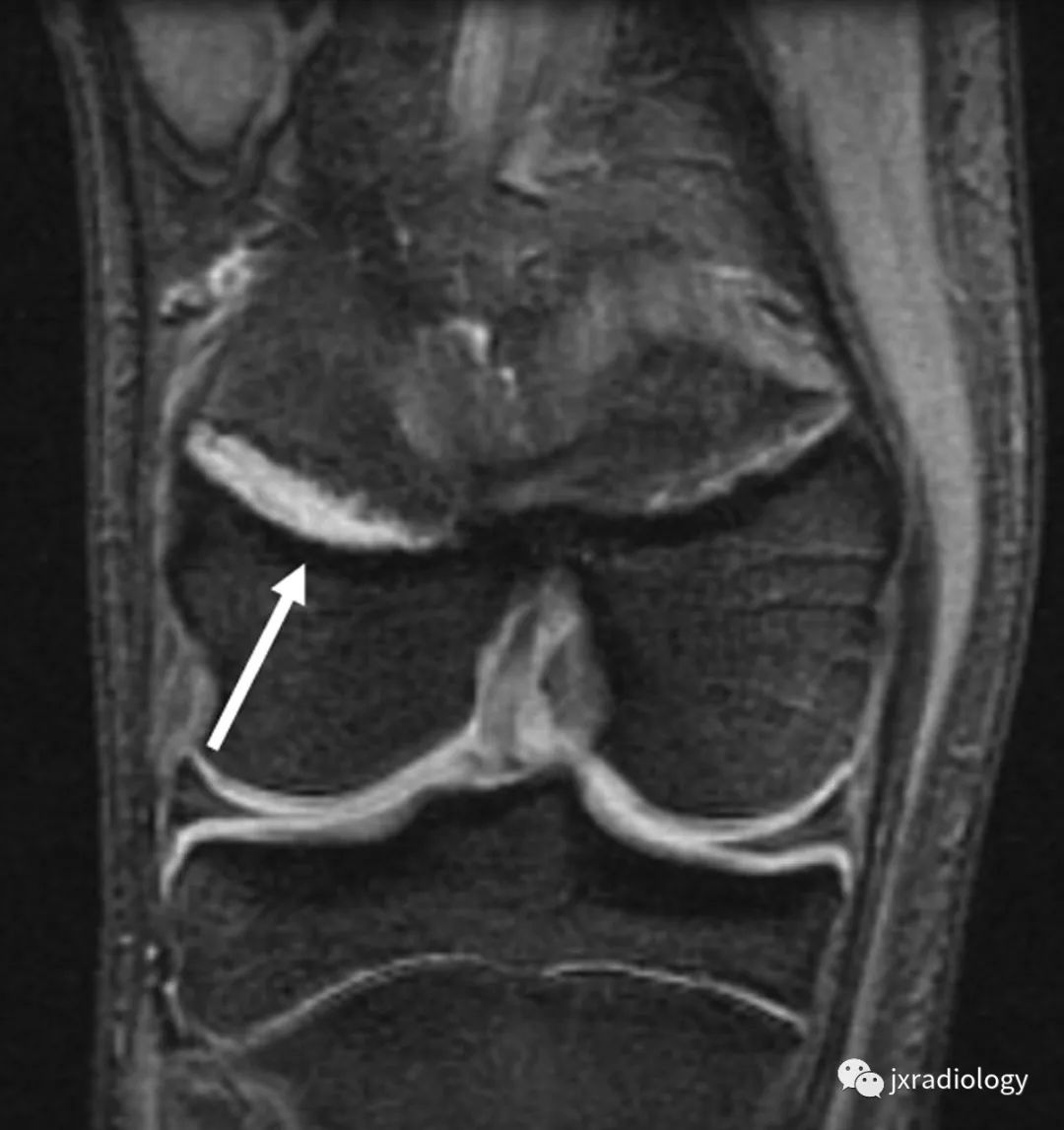 影像PPT - 认识青少年运动损伤的慢性骺板(生长板)损伤 Chronic Physeal (Growth Plate) Injuries-4 影像PPT - 认识青少年运动损伤的慢性骺板(生长板)损伤 Chronic Physeal (Growth Plate) Injuries-4