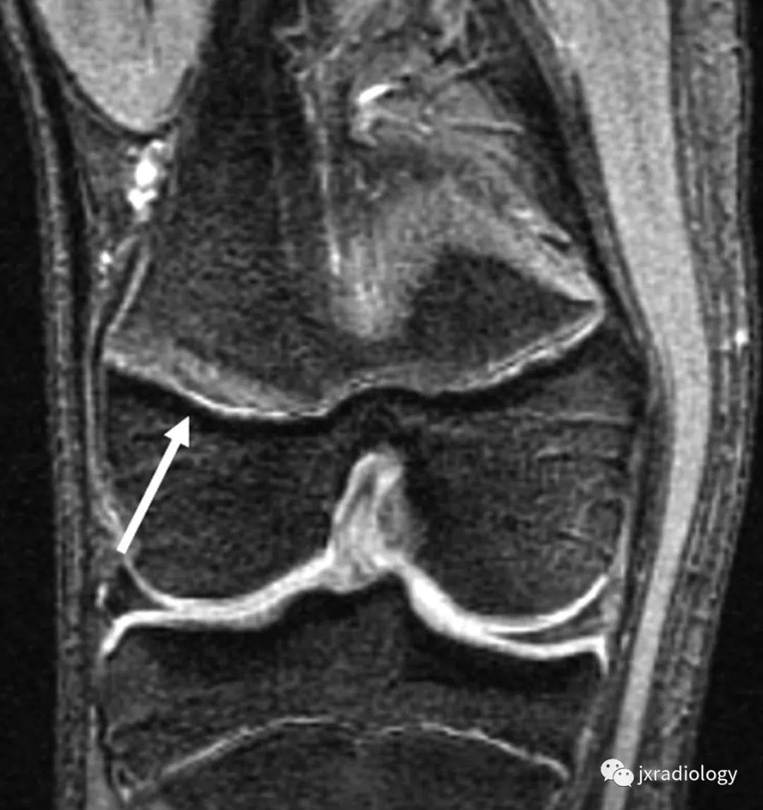 影像PPT - 认识青少年运动损伤的慢性骺板(生长板)损伤 Chronic Physeal (Growth Plate) Injuries-5 影像PPT - 认识青少年运动损伤的慢性骺板(生长板)损伤 Chronic Physeal (Growth Plate) Injuries-5