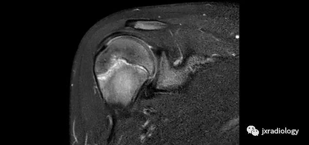 影像PPT - 认识青少年运动损伤的慢性骺板(生长板)损伤 Chronic Physeal (Growth Plate) Injuries-8 影像PPT - 认识青少年运动损伤的慢性骺板(生长板)损伤 Chronic Physeal (Growth Plate) Injuries-8
