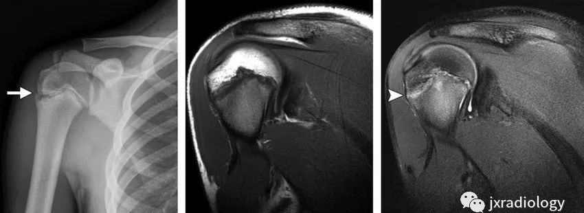 影像PPT - 认识青少年运动损伤的慢性骺板(生长板)损伤 Chronic Physeal (Growth Plate) Injuries-9 影像PPT - 认识青少年运动损伤的慢性骺板(生长板)损伤 Chronic Physeal (Growth Plate) Injuries-9