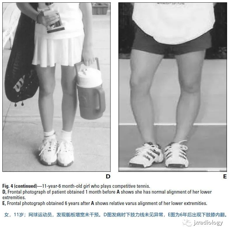 影像PPT - 认识青少年运动损伤的慢性骺板(生长板)损伤 Chronic Physeal (Growth Plate) Injuries-10 影像PPT - 认识青少年运动损伤的慢性骺板(生长板)损伤 Chronic Physeal (Growth Plate) Injuries-10
