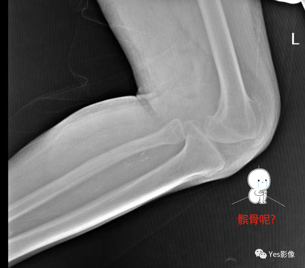 影像PPT - 指甲-髌骨综合征(nail-patellasyndrome,NPS)-1 影像PPT - 指甲-髌骨综合征(nail-patellasyndrome,NPS)-1