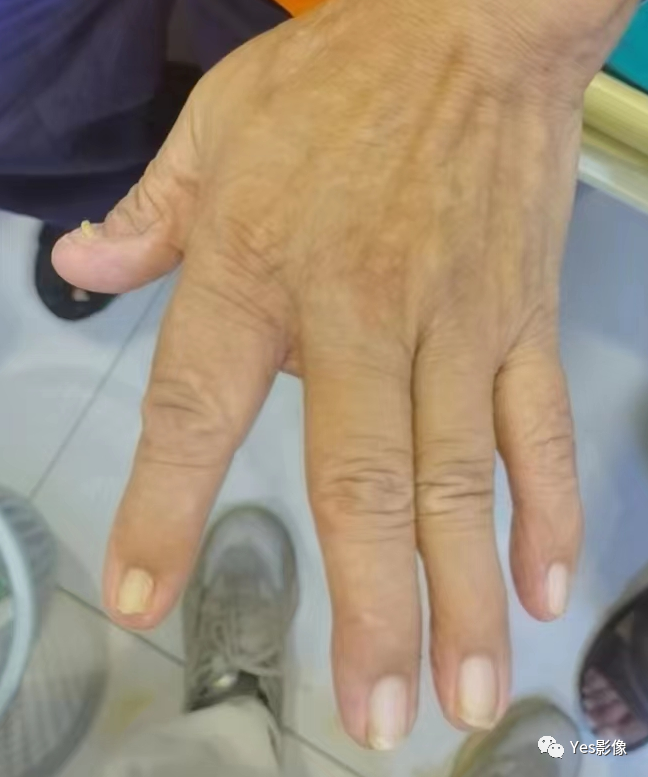 影像PPT - 指甲-髌骨综合征(nail-patellasyndrome,NPS)-5 影像PPT - 指甲-髌骨综合征(nail-patellasyndrome,NPS)-5