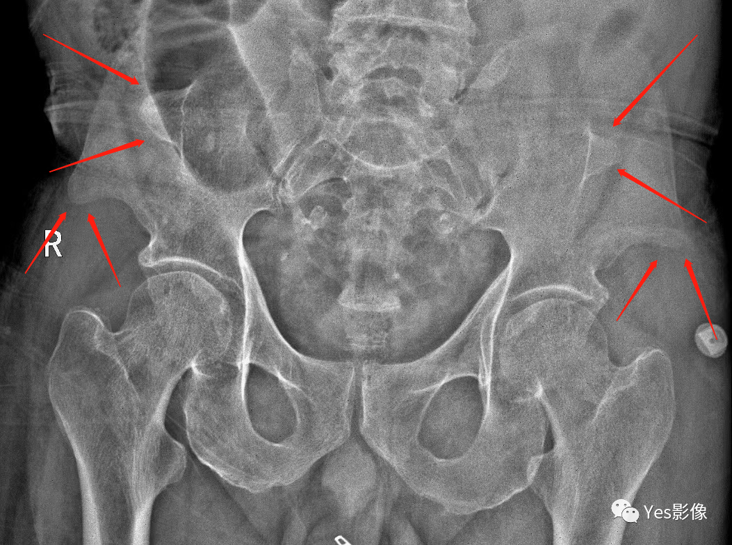影像PPT - 指甲-髌骨综合征(nail-patellasyndrome,NPS)-4 影像PPT - 指甲-髌骨综合征(nail-patellasyndrome,NPS)-4