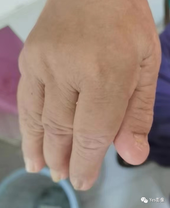 影像PPT - 指甲-髌骨综合征(nail-patellasyndrome,NPS)-6 影像PPT - 指甲-髌骨综合征(nail-patellasyndrome,NPS)-6