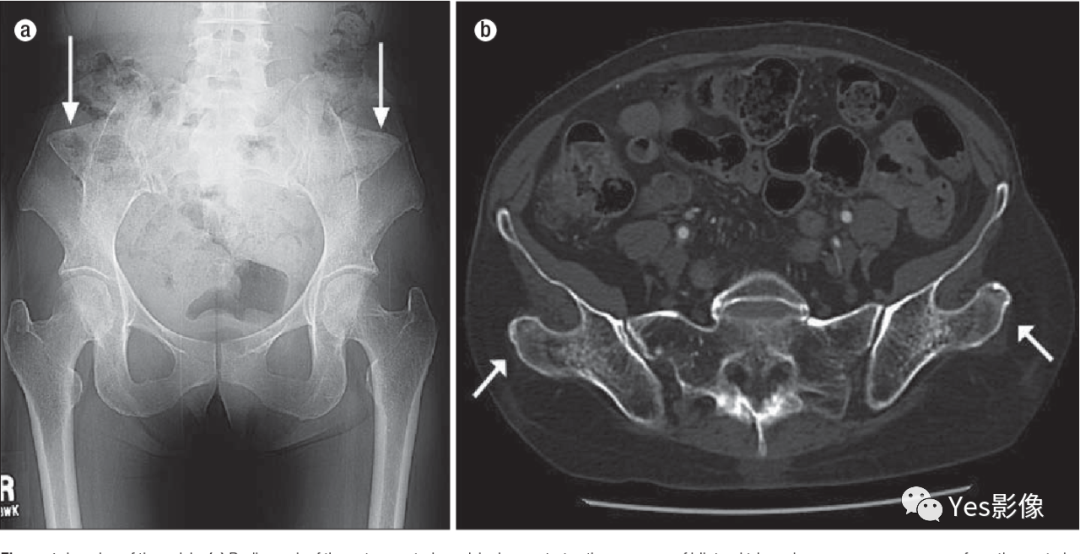 影像PPT - 指甲-髌骨综合征（nail-patellasyndrome,NPS）-7