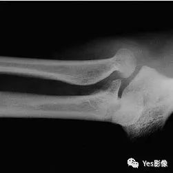 影像PPT - 指甲-髌骨综合征(nail-patellasyndrome,NPS)-9 影像PPT - 指甲-髌骨综合征(nail-patellasyndrome,NPS)-9