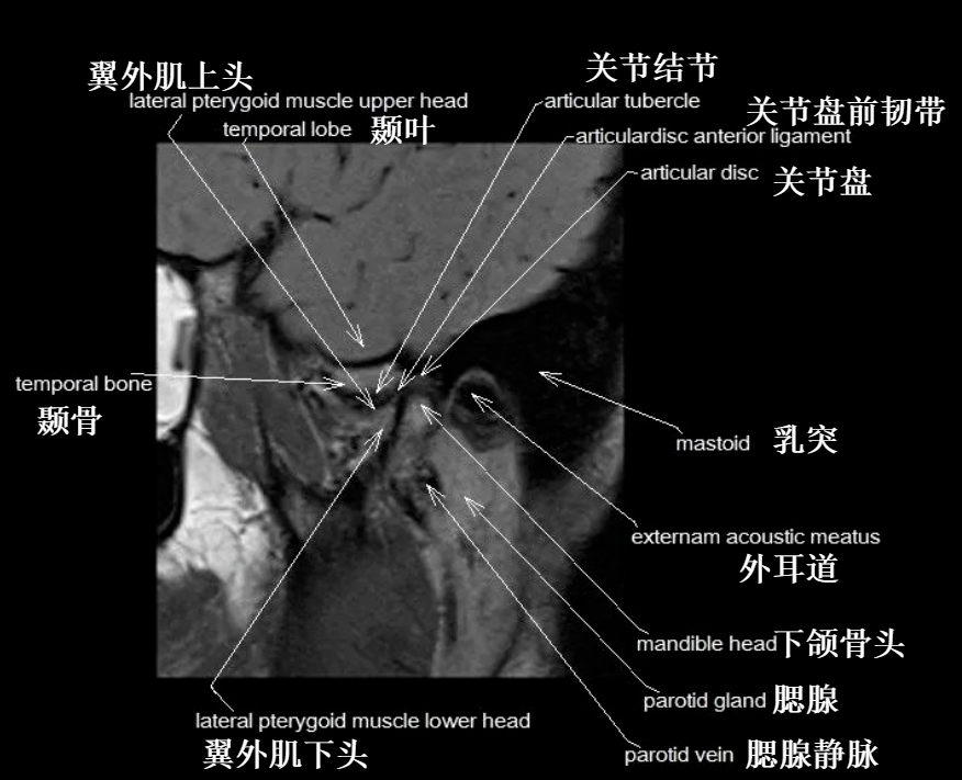 影像PPT - 颞下颌关节影像解剖-5 影像PPT - 颞下颌关节影像解剖-5