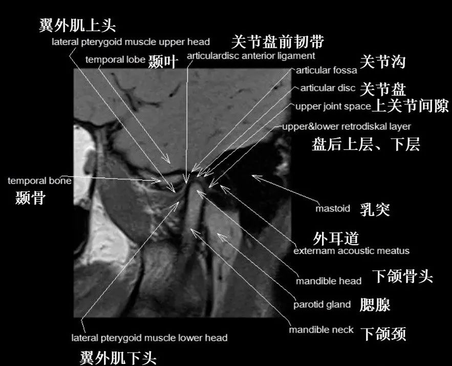 影像PPT - 颞下颌关节影像解剖-6 影像PPT - 颞下颌关节影像解剖-6