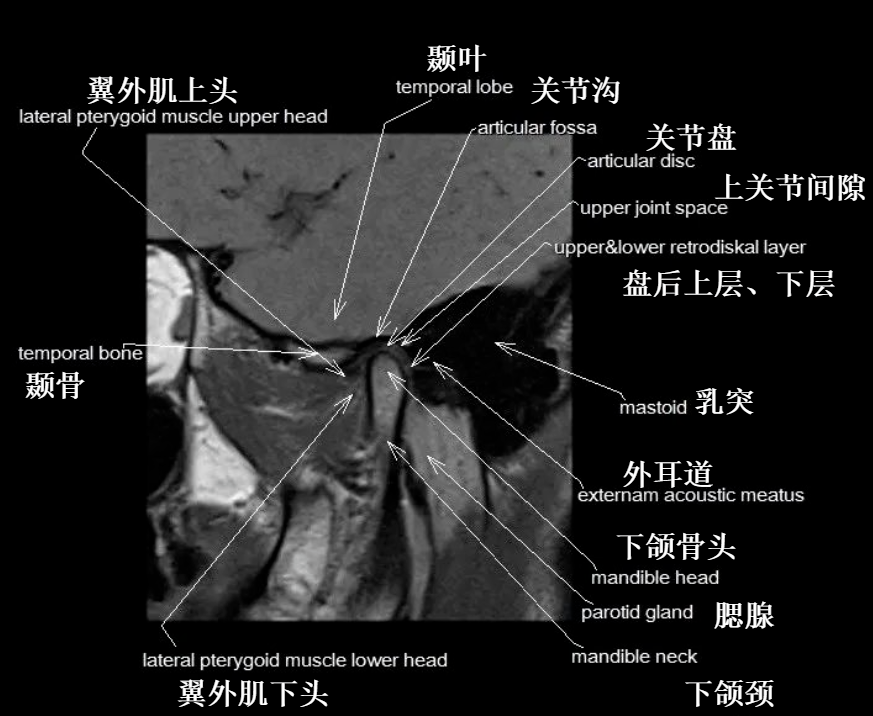 影像PPT - 颞下颌关节影像解剖-7 影像PPT - 颞下颌关节影像解剖-7