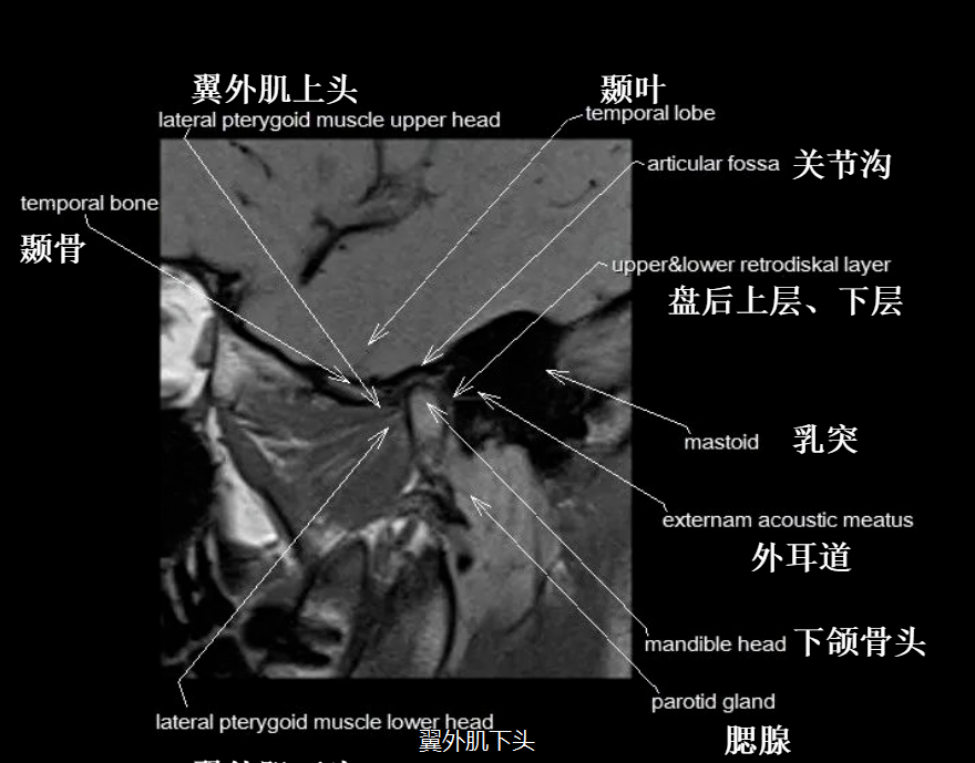 影像PPT - 颞下颌关节影像解剖-8 影像PPT - 颞下颌关节影像解剖-8