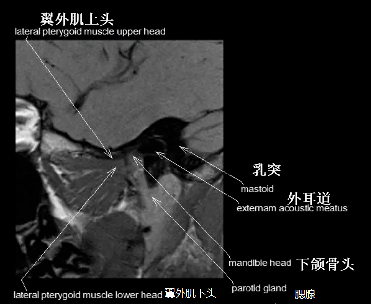 影像PPT - 颞下颌关节影像解剖-9 影像PPT - 颞下颌关节影像解剖-9