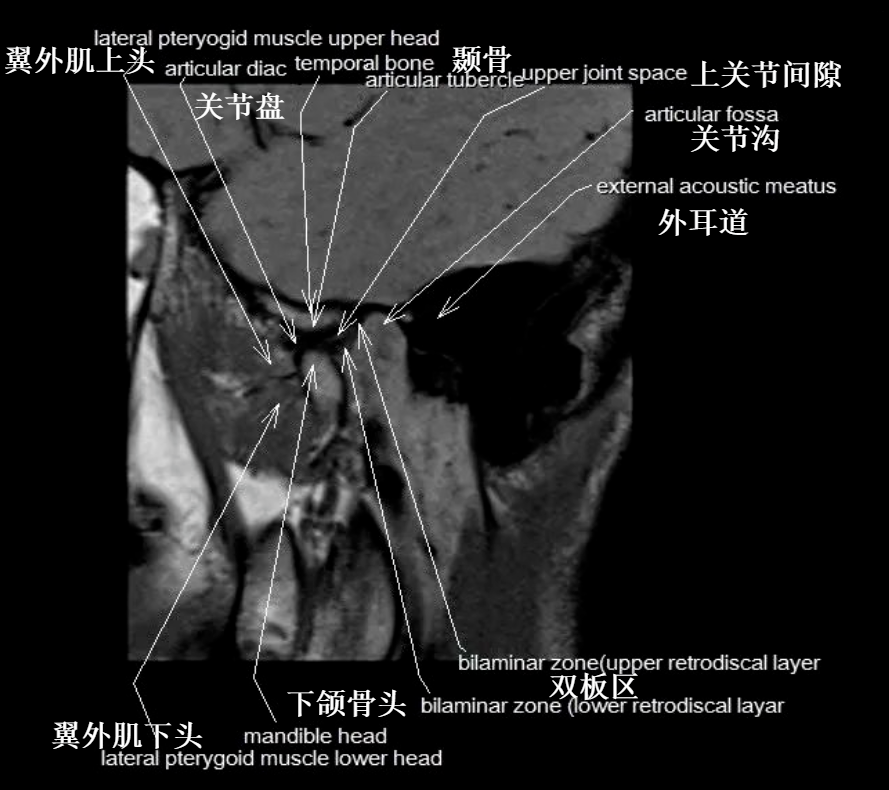 影像PPT - 颞下颌关节影像解剖-10 影像PPT - 颞下颌关节影像解剖-10