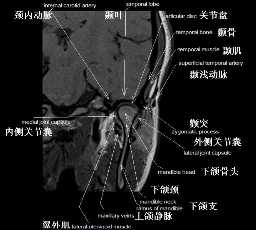 影像PPT - 颞下颌关节影像解剖-11 影像PPT - 颞下颌关节影像解剖-11