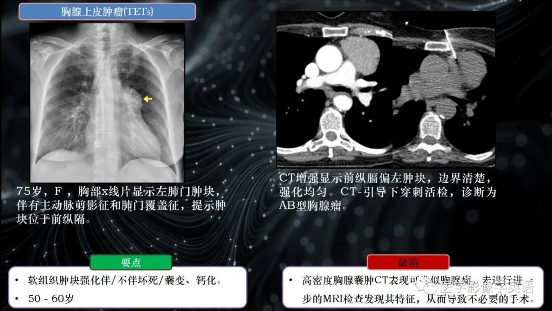 影像PPT - 【PPT】前纵隔肿块诊断要点及缺陷-14 影像PPT - 【PPT】前纵隔肿块诊断要点及缺陷-14