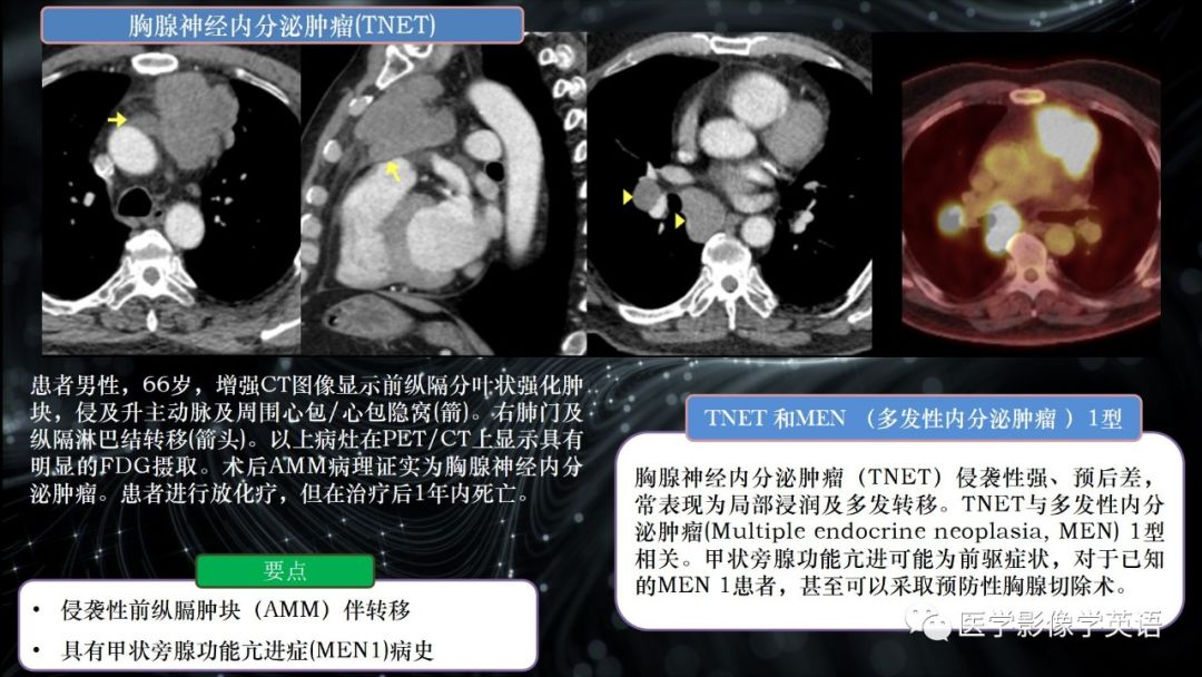 影像PPT - 【PPT】前纵隔肿块诊断要点及缺陷-16 影像PPT - 【PPT】前纵隔肿块诊断要点及缺陷-16