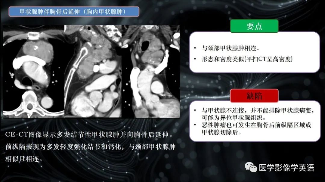 影像PPT - 【PPT】前纵隔肿块诊断要点及缺陷-18 影像PPT - 【PPT】前纵隔肿块诊断要点及缺陷-18