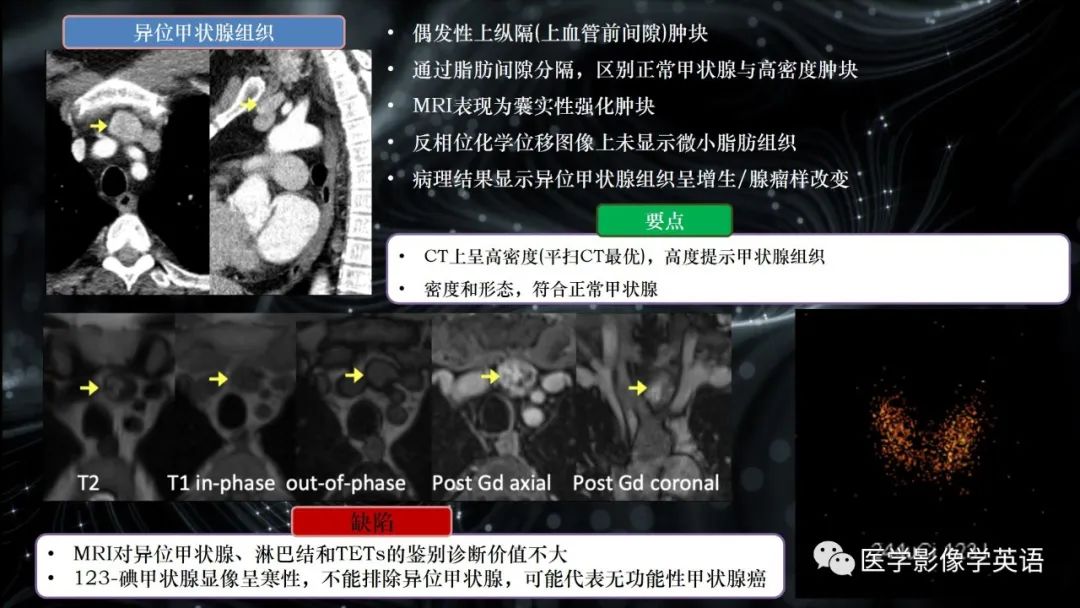 影像PPT - 【PPT】前纵隔肿块诊断要点及缺陷-20 影像PPT - 【PPT】前纵隔肿块诊断要点及缺陷-20
