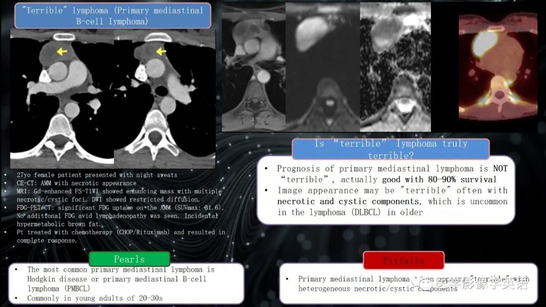 影像PPT - 【PPT】前纵隔肿块诊断要点及缺陷-23 影像PPT - 【PPT】前纵隔肿块诊断要点及缺陷-23