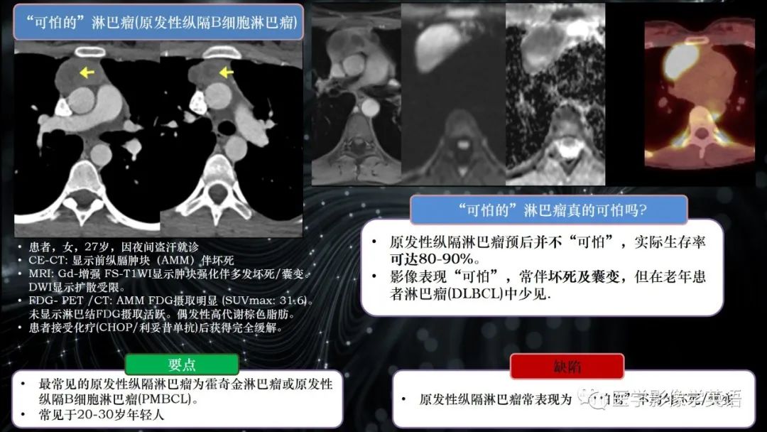 影像PPT - 【PPT】前纵隔肿块诊断要点及缺陷-24 影像PPT - 【PPT】前纵隔肿块诊断要点及缺陷-24