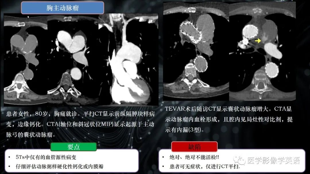 影像PPT - 【PPT】前纵隔肿块诊断要点及缺陷-26 影像PPT - 【PPT】前纵隔肿块诊断要点及缺陷-26