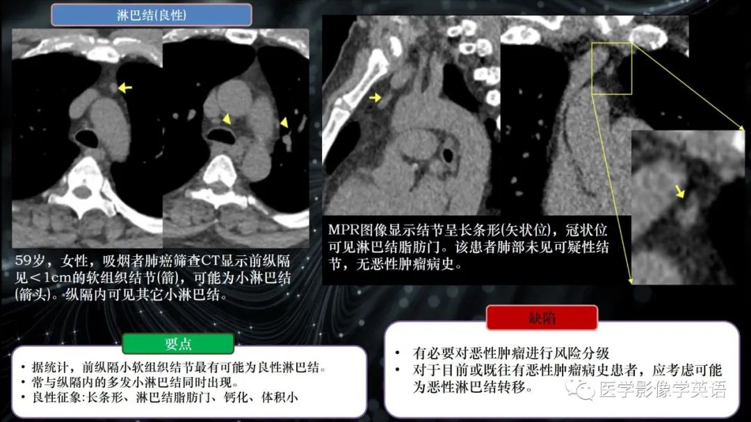 影像PPT - 【PPT】前纵隔肿块诊断要点及缺陷-30 影像PPT - 【PPT】前纵隔肿块诊断要点及缺陷-30
