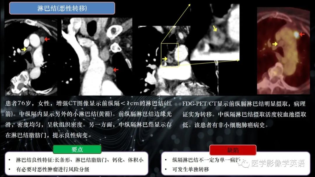 影像PPT - 【PPT】前纵隔肿块诊断要点及缺陷-32 影像PPT - 【PPT】前纵隔肿块诊断要点及缺陷-32