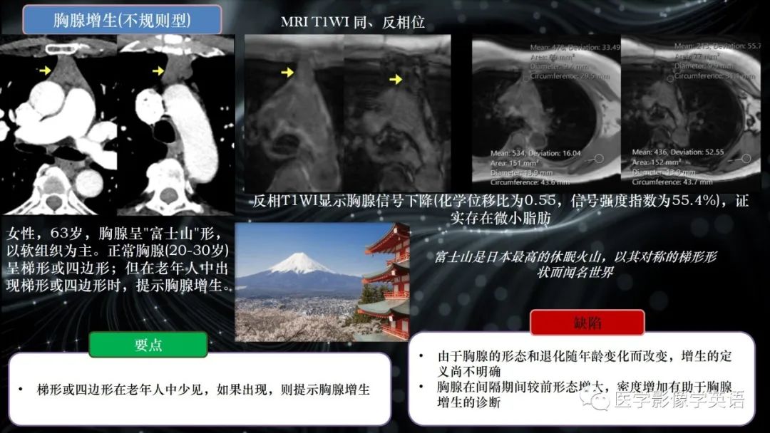影像PPT - 【PPT】前纵隔肿块诊断要点及缺陷-42 影像PPT - 【PPT】前纵隔肿块诊断要点及缺陷-42