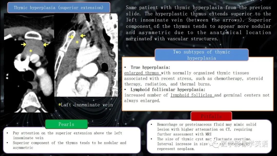 影像PPT - 【PPT】前纵隔肿块诊断要点及缺陷-43 影像PPT - 【PPT】前纵隔肿块诊断要点及缺陷-43