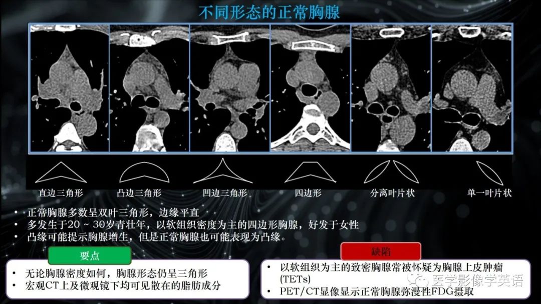 影像PPT - 【PPT】前纵隔肿块诊断要点及缺陷-46 影像PPT - 【PPT】前纵隔肿块诊断要点及缺陷-46