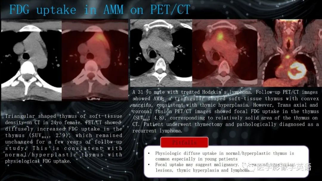 影像PPT - 【PPT】前纵隔肿块诊断要点及缺陷-65 影像PPT - 【PPT】前纵隔肿块诊断要点及缺陷-65
