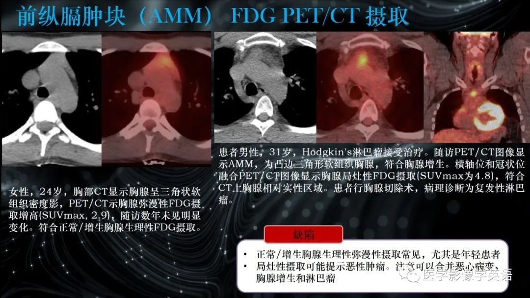影像PPT - 【PPT】前纵隔肿块诊断要点及缺陷-66 影像PPT - 【PPT】前纵隔肿块诊断要点及缺陷-66