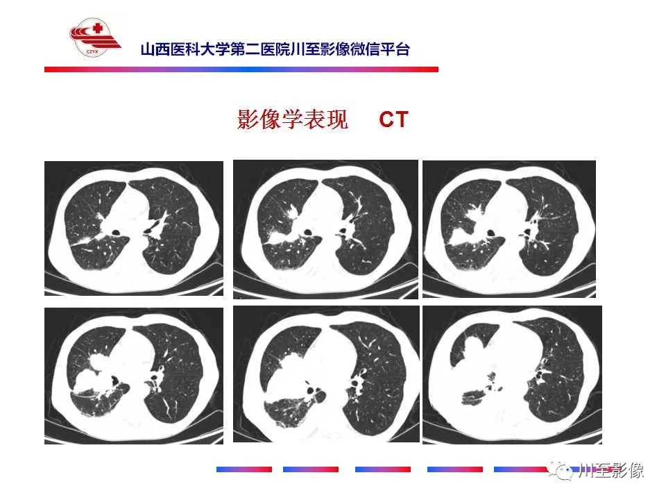 影像PPT - 【PPT】周围型肺癌-4