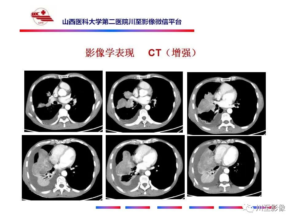 影像PPT - 【PPT】周围型肺癌-5