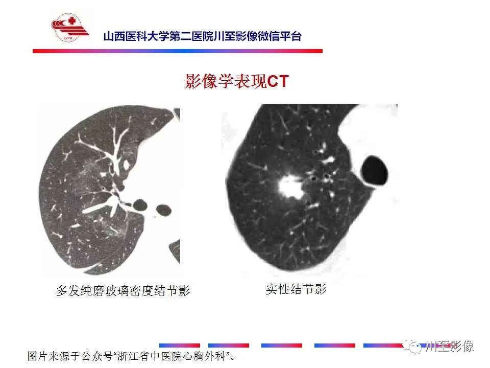 影像PPT - 【PPT】周围型肺癌-14