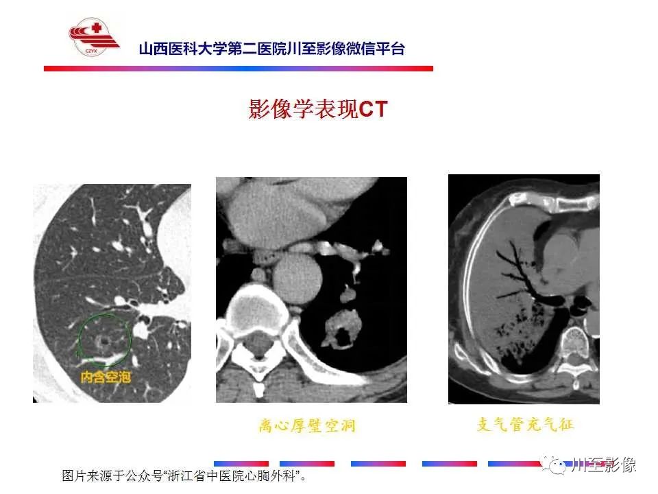 影像PPT - 【PPT】周围型肺癌-15