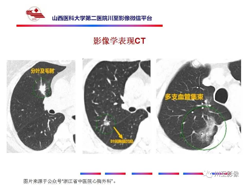 影像PPT - 【PPT】周围型肺癌-16