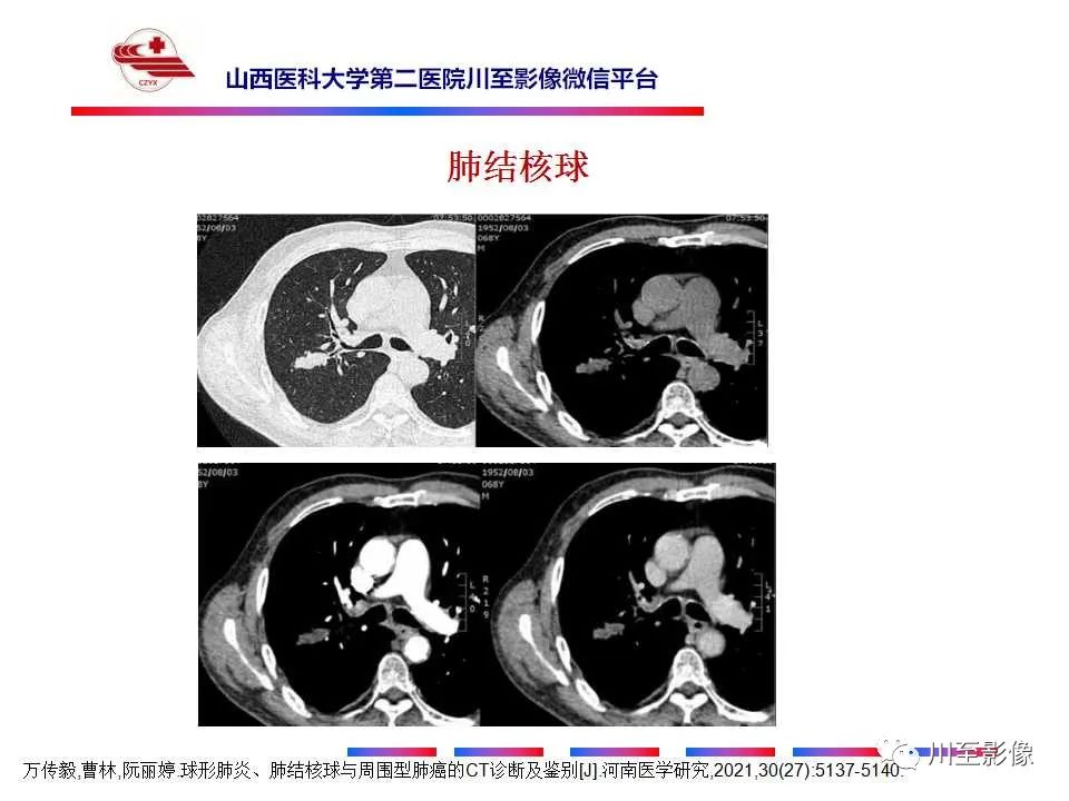 影像PPT - 【PPT】周围型肺癌-22