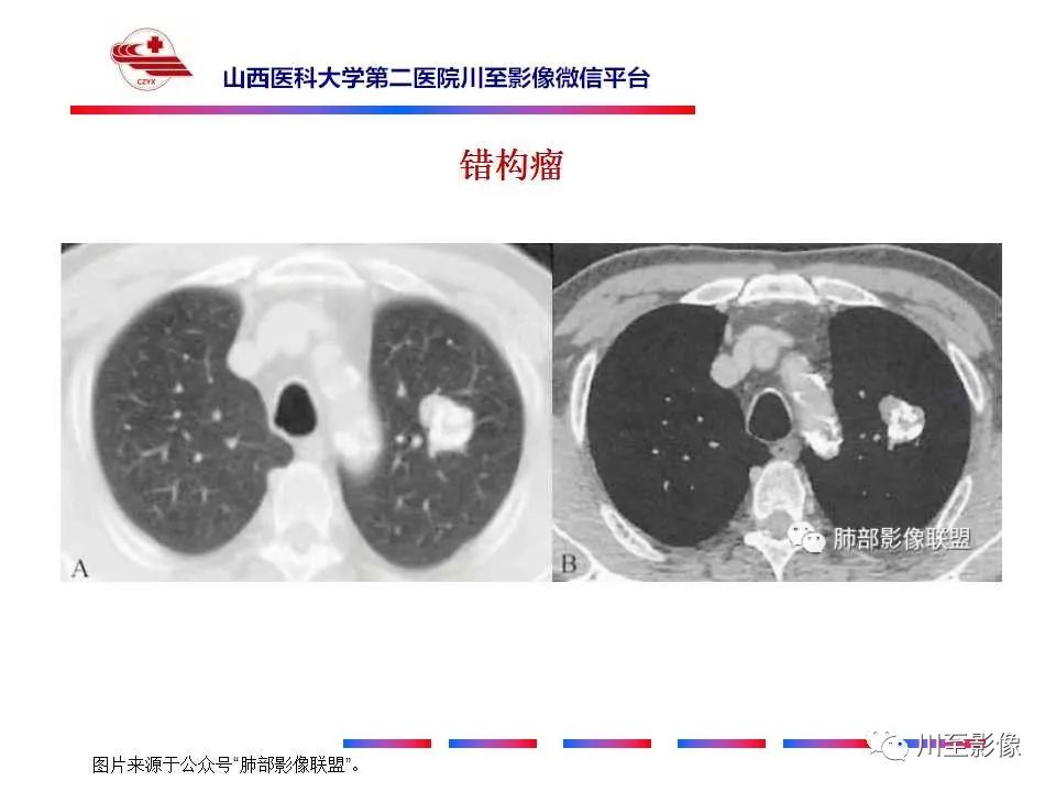 影像PPT - 【PPT】周围型肺癌-24