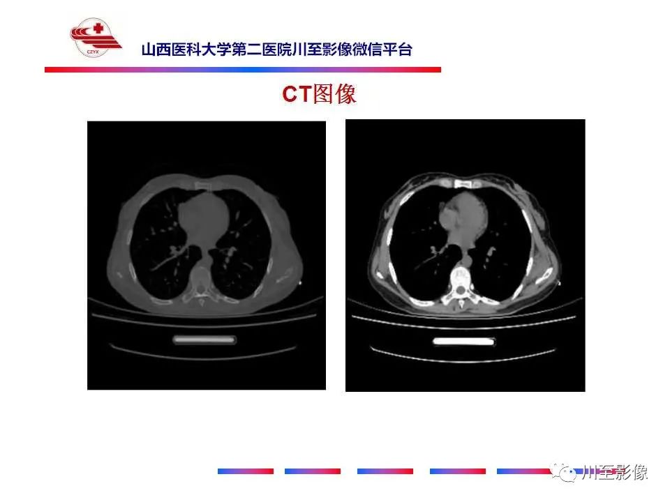 影像PPT - 【PPT】弹力纤维瘤-3