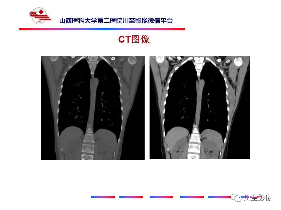 影像PPT - 【PPT】弹力纤维瘤-4