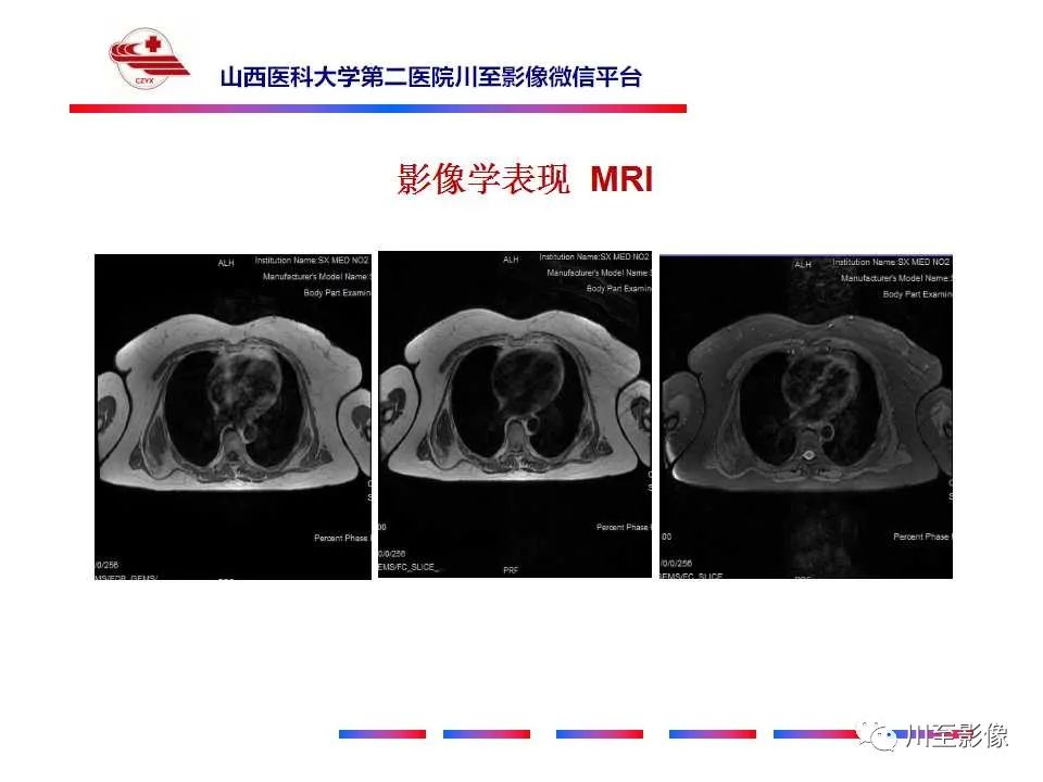 影像PPT - 【PPT】弹力纤维瘤-8